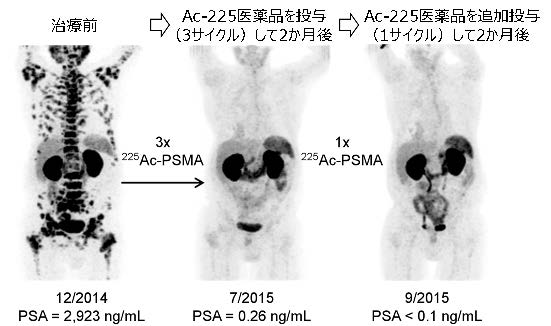2016年にハイデルベルク大学のチームが発表した、Ac-225による前立腺がん治療効果