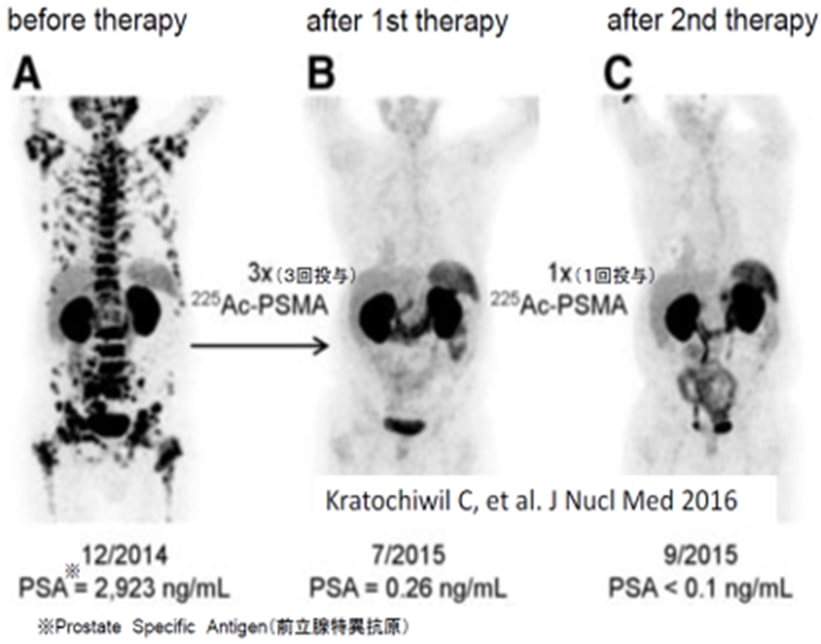 &alpha;線放出RIによる治療例