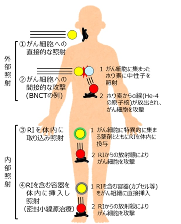 外部照射/内部照射による治療の模式図